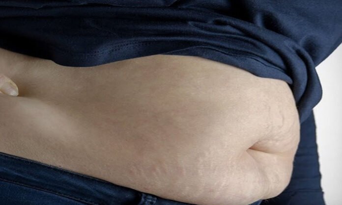 Obesity is on the rise Obesity is on the rise
