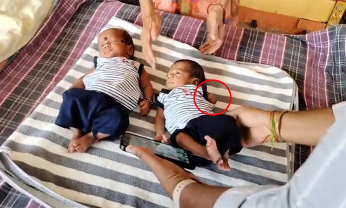Alleged medical negligence at Khammam Government MCH Center reportedly resulted in a severe infection and arm amputation for a premature infant.